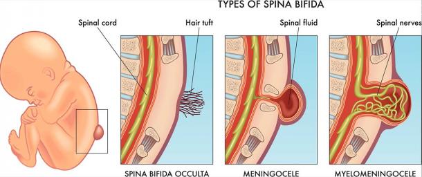 Spina bifida hastalığı